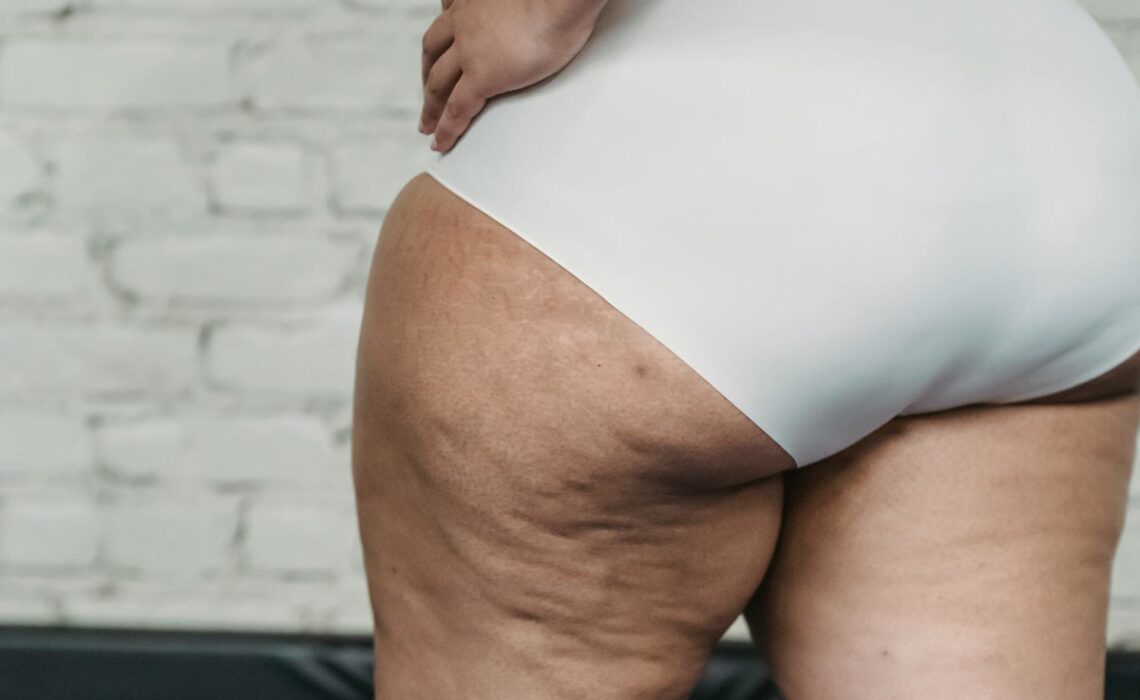 cellulite aux cuisses 